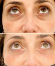 MEN EXPERT - ROLLER ANTI OJERAS